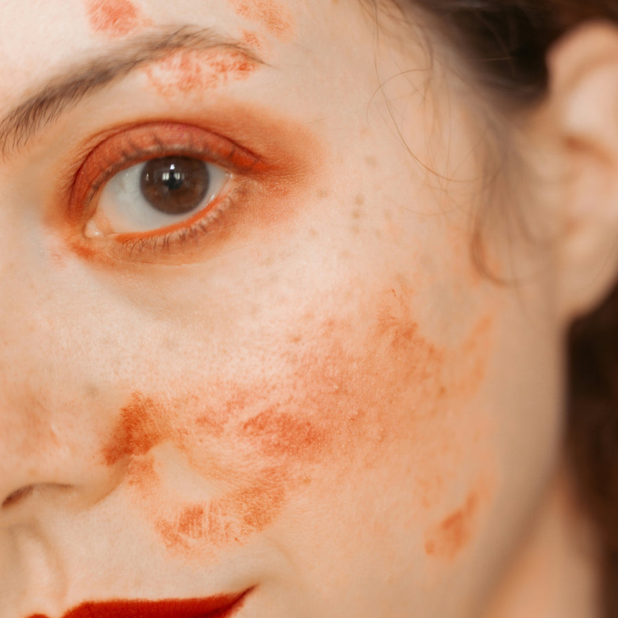 Ritual Acné, eccema, dermatitis, psoriasis